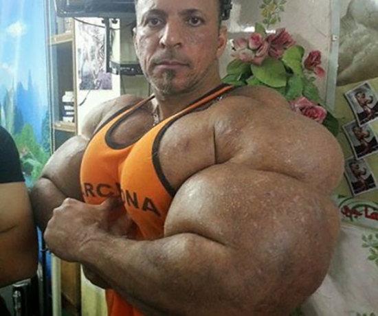 Synthol: il farmaco per bodybuilders che ti gonfia come un palloncino