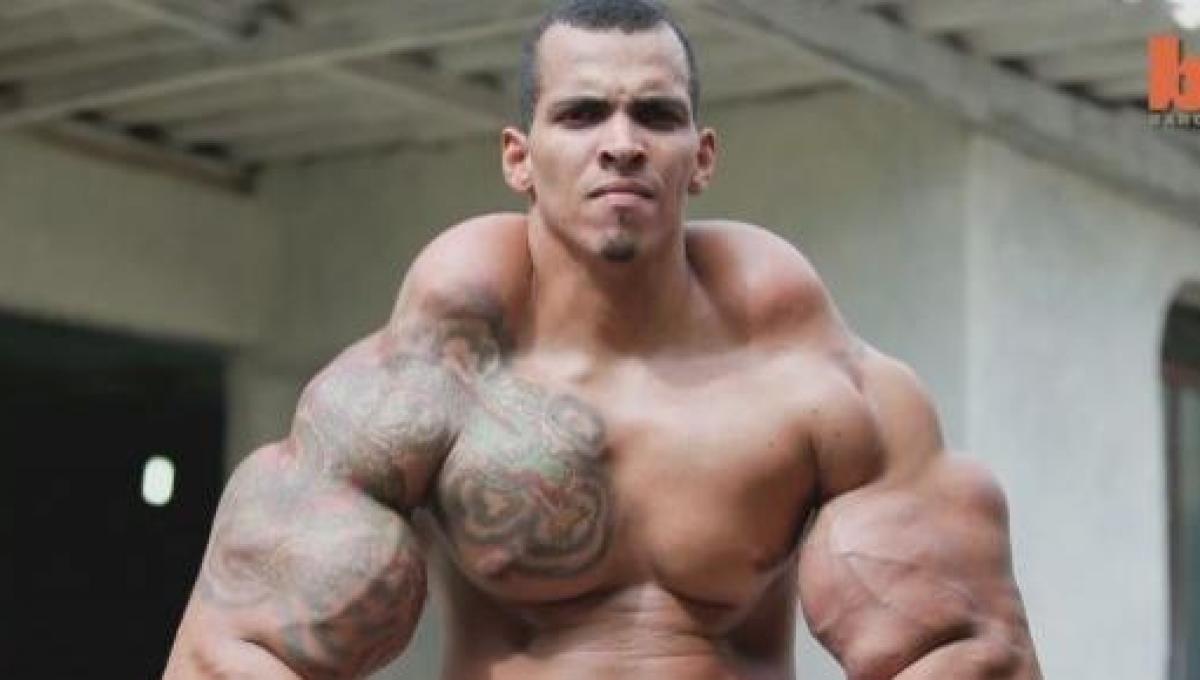 Per essersi iniettato Synthol nei bicipiti un bodybuilder ha quasi perso le braccia